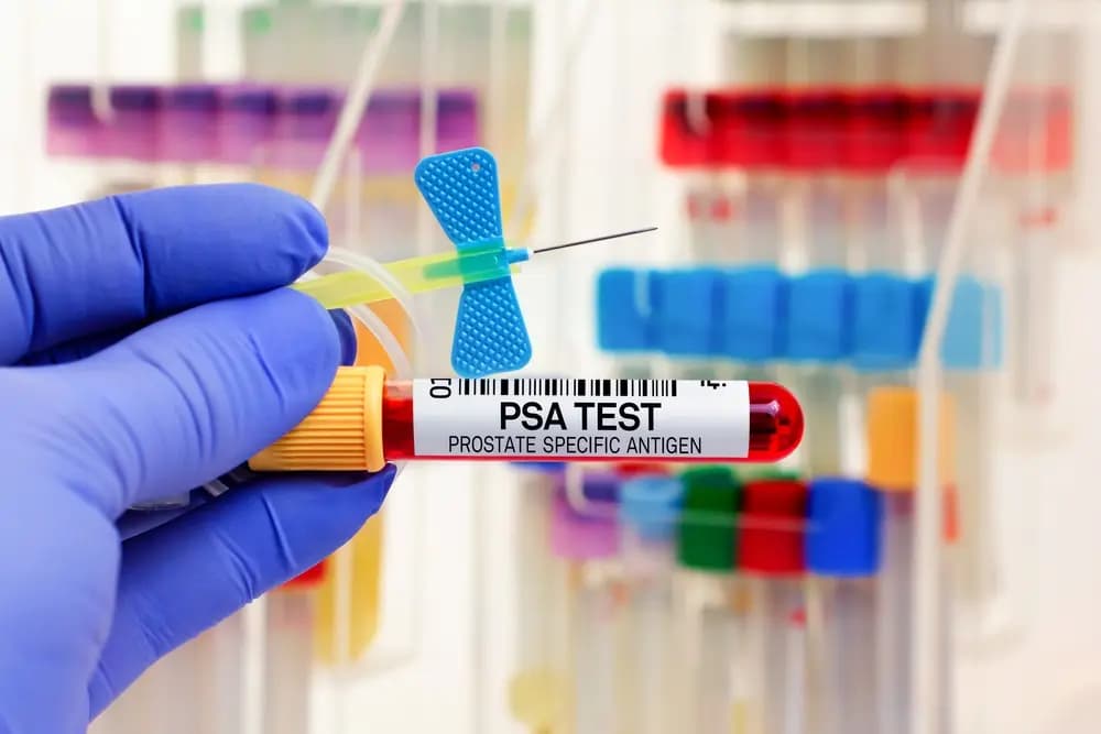 PSA-szűrés nem elegendő PSA-szűrés nem elegendő